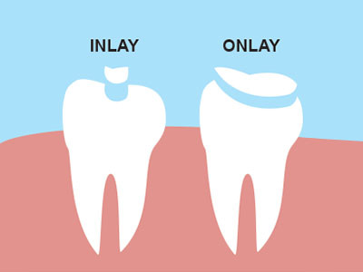 inlay-onlay