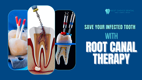 Root Canal – Boca Raton, FL