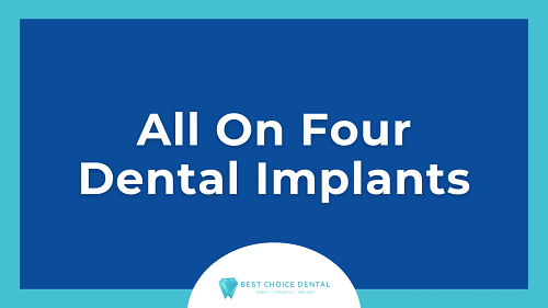 All-on-4 Dental Implants: A Lasting Solution for Missing Teeth in Boca Raton, FL