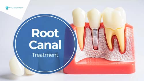 Understanding Root Canals and Returning to Normal Life in Boca Raton, FL