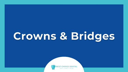 Understanding Crowns and Bridges: Do You Need to Alter Your Teeth for a Better Smile in Boca Raton, FL