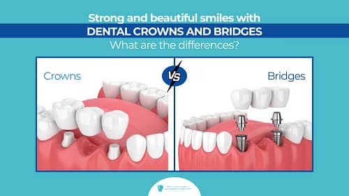 Can Dental Crowns or Bridges Develop Cavities? in Boca Raton