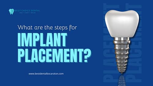 Implant placement – Boca Raton, FL