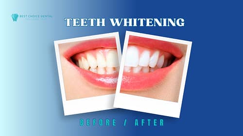 Teeth Whitening – Boca Raton, FL