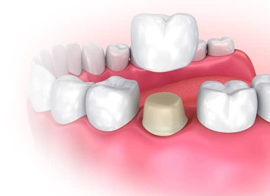 dental-crown