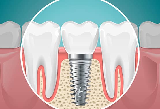 Dental Implant