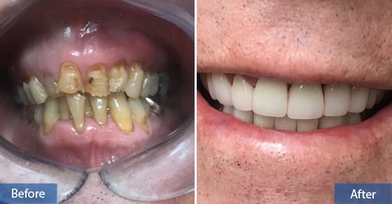 poorly aligned and stained teeth can be repaired
